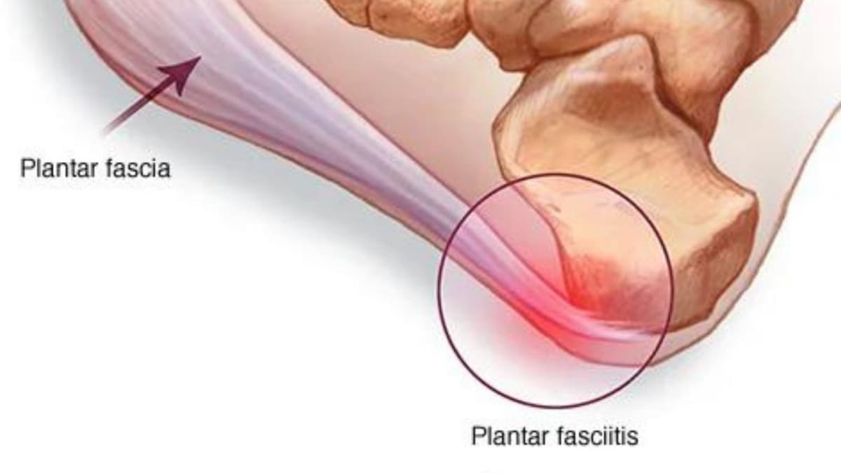 La fascitis plantar es una de las causas más comunes de dolor de talón. //Foto: Cortesía.